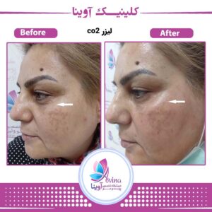 نمونه کار جوانسازی پوست در کلینیک آوینا