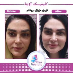 نمونه کار جوانسازی پوست در کلینیک آوینا