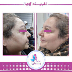 نمونه کار جوانسازی پوست در کلینیک آوینا