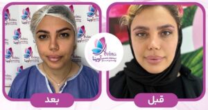 بلفاروپلاستی در کلینیک آوینا