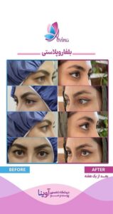 بلفاروپلاستی در کلینیک آوینا