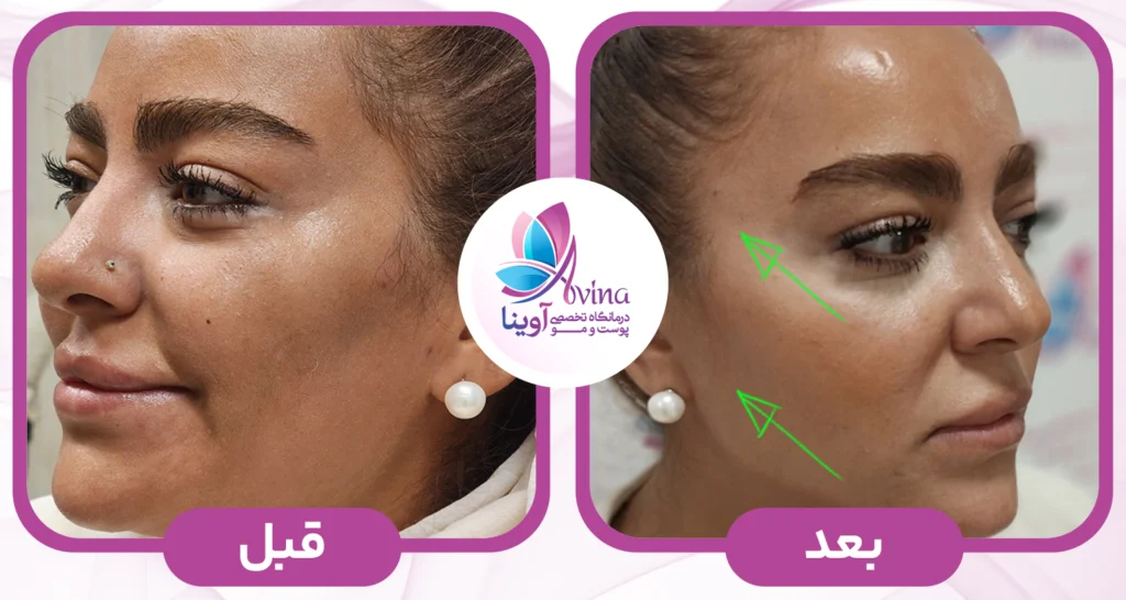 لیفت با نخ در کلینیک آوینا