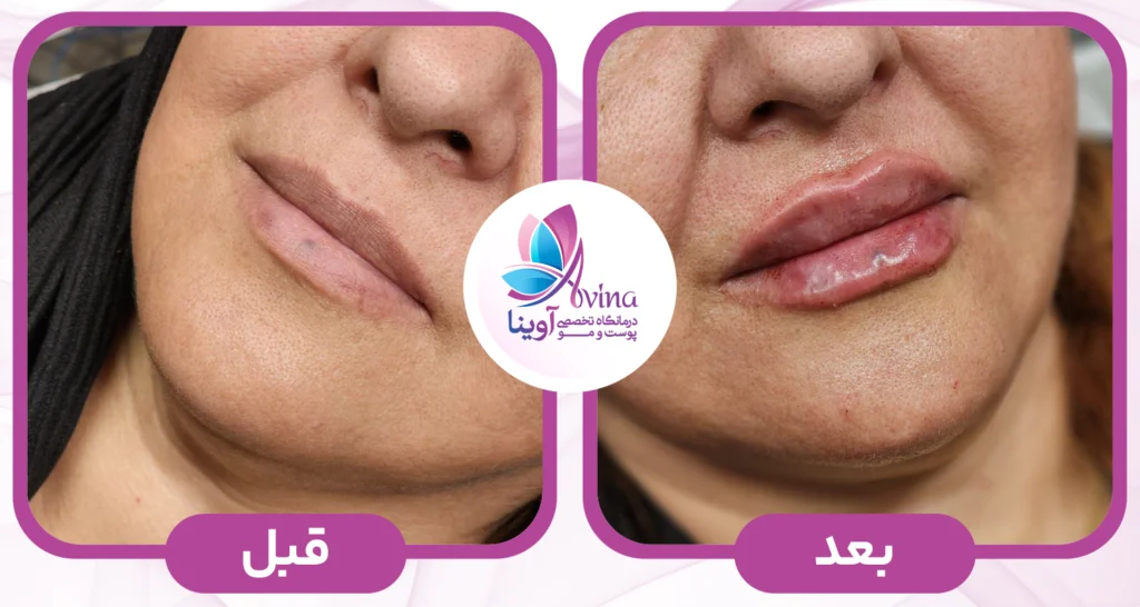 تزریق ژل در کلینیک آوینا