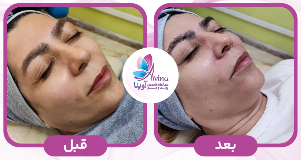 کاندیدای مناسب برای فیشیال پوست