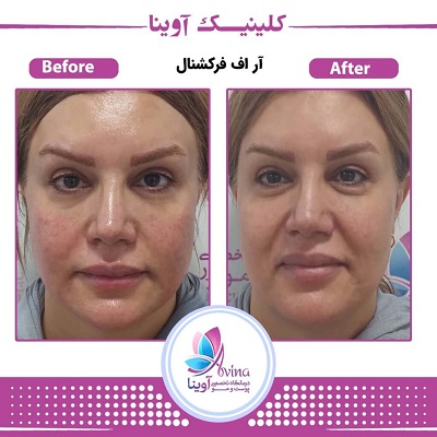 نمونه کار فرکشنال در کلینیک آوینا