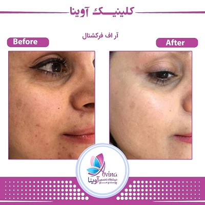 نمونه کار فرکشنال در کلینیک آوینا