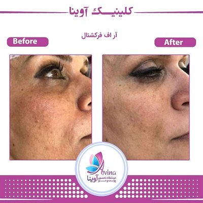 نمونه کار فرکشنال در کلینیک آوینا