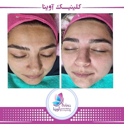 نمونه کار فیشیال در کلینیک آوینا