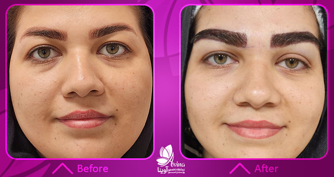 نمونه کار کاشت ابرو در کلینیک آوینا