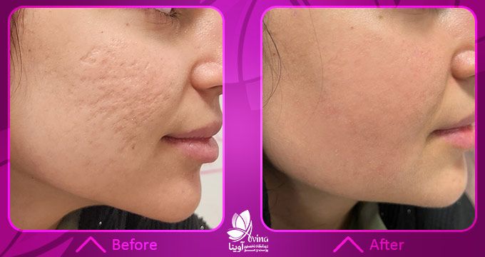 نمونه کار تزریق ژل گونه در کلینیک آوینا1