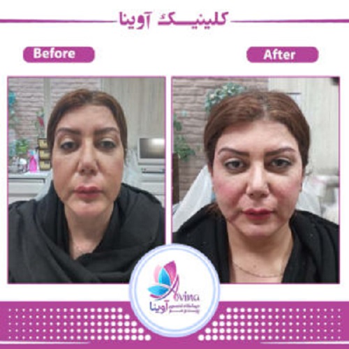 نمونه کار لیفت صورت با نخ در کلینیک آوینا