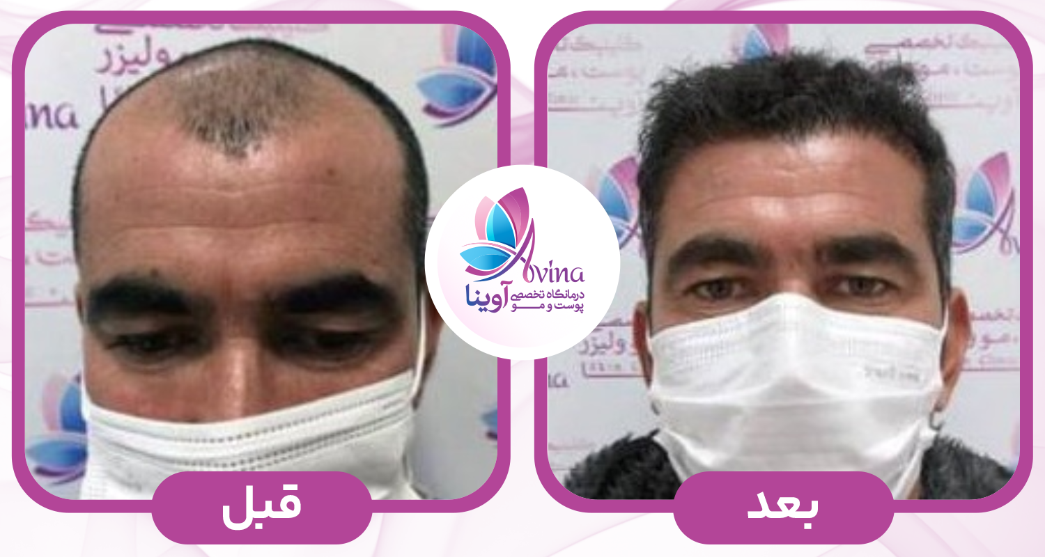 کاشت مو در کلینیک آوینا