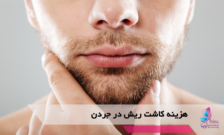 هزینه کاشت ریش در جردن