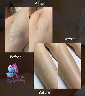 نمونه کار لیزر موهای زائد در کلینیک آوینا