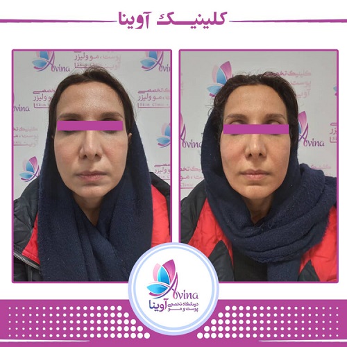 نمونه کار لیفت صورت با نخ در کلینیک آوینا