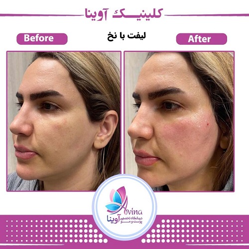 نمونه کار لیفت صورت با نخ در کلینیک آوینا