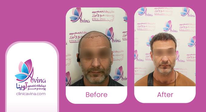 نمونه کار کاشت مو در کلینیک آوینا