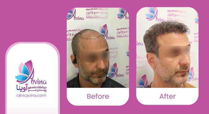 نمونه کار کاشت مو در کلینیک آوینا