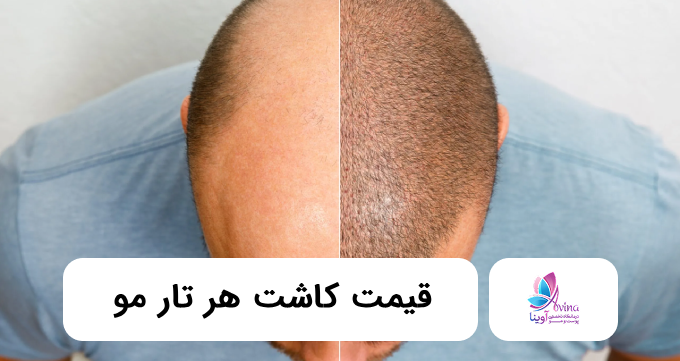 قیمت کاشت هر تار مو ✅【سال1405】❤️