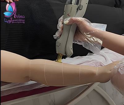 مزایای لیزر موهای زائد نسبت به روشهای سنتی