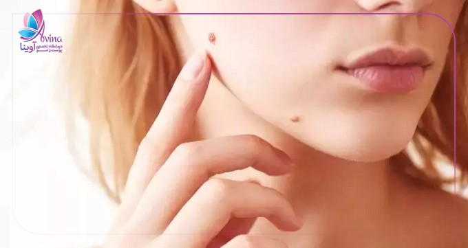 بهترین پماد بعد از برداشتن خال