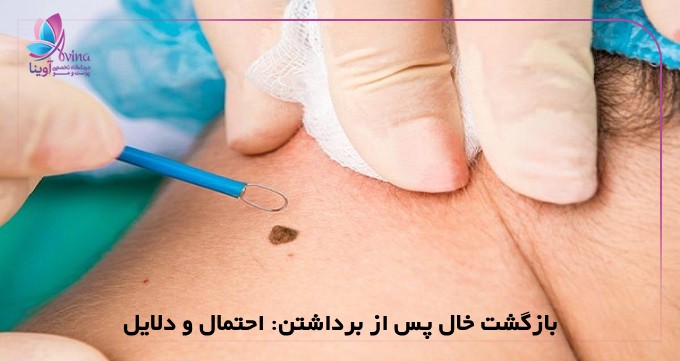بازگشت خال پس از برداشتن: احتمال و دلایل