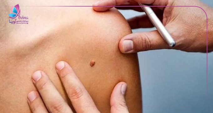 چه افرادی نباید خال برداری کنند؟