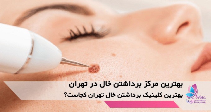 بهترین مرکز برداشتن خال در تهران