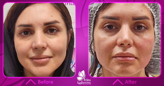 سابسیژن در کلینیک آوینا