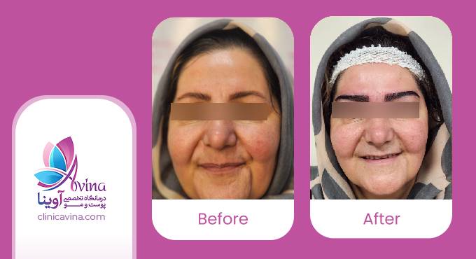 نمونه کار کاشت ابرو در کلینیک آوینا