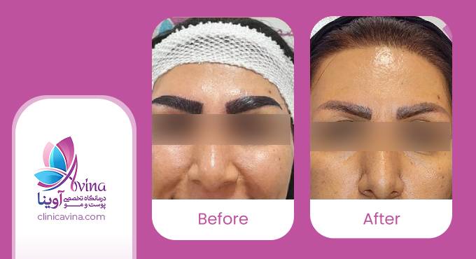 نمونه کار کاشت ابرو در کلینیک آوینا