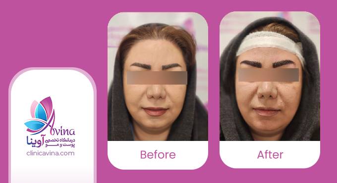 نمونه کار کاشت ابرو در کلینیک آوینا