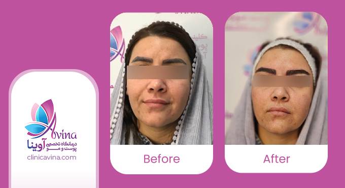 نمونه کار کاشت ابرو در کلینیک آوینا