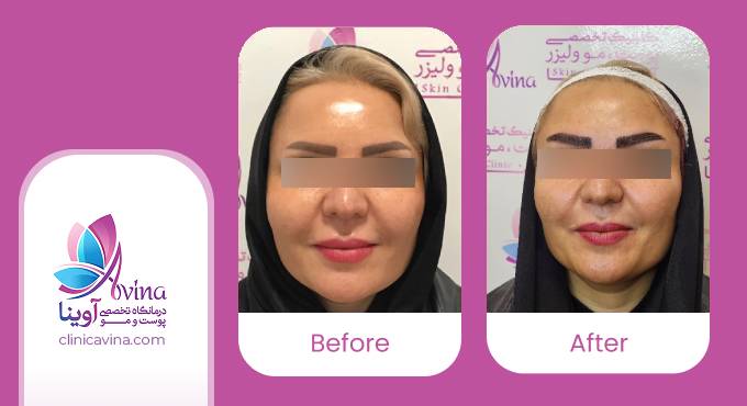 نمونه کار کاشت ابرو در کلینیک آوینا