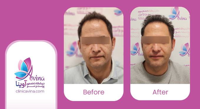نمونه کار کاشت مو در کلینیک آوینا