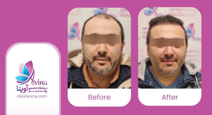 نمونه کار کاشت مو در کلینیک آوینا