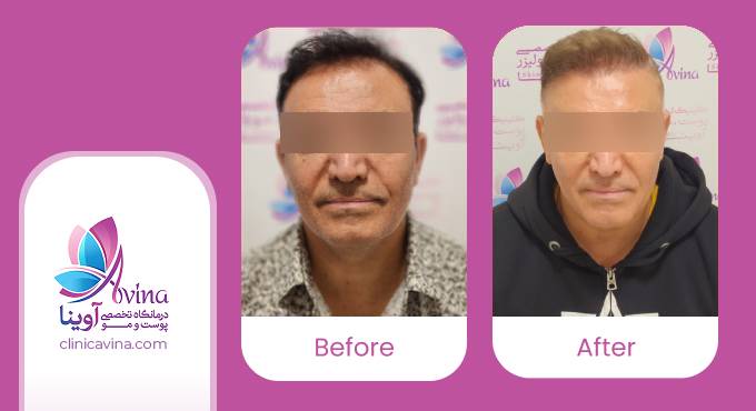 نمونه کار کاشت مو در کلینیک آوینا