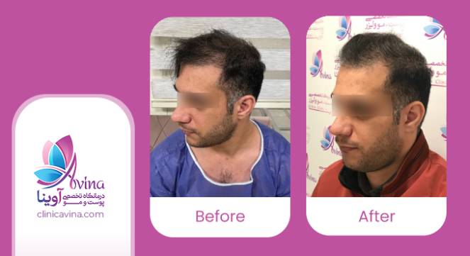 نمونه کار کاشت مو در کلینیک آوینا