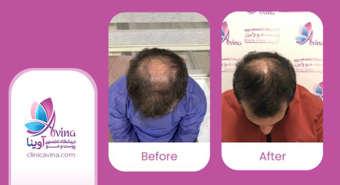 نمونه کار کاشت مو در کلینیک آوینا