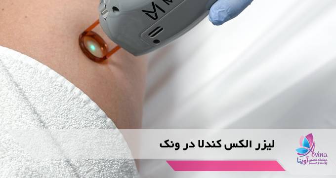 لیزر الکس کندلا در ونک