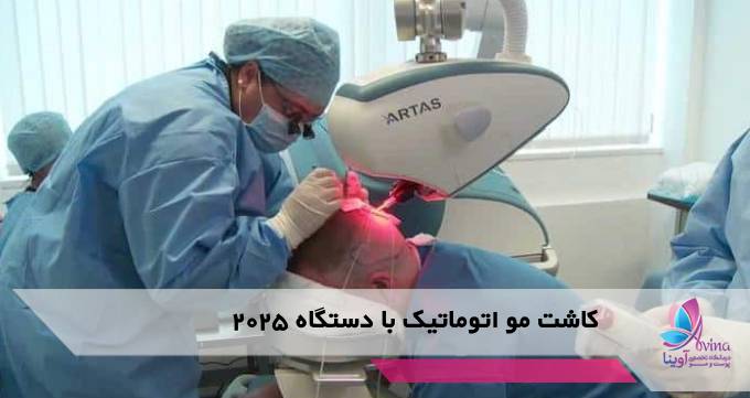 کاشت مو اتوماتیک با دستگاه ۲۰۲۵