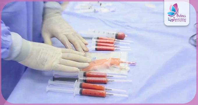 روشهای تزریق چربی باسن توسط بهترین دکتر تهران