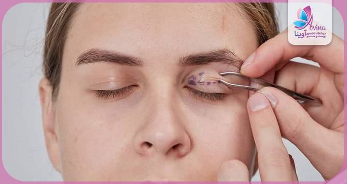 تکنیکهای نوین بلفاروپلاستی توسط بهترین جراح
