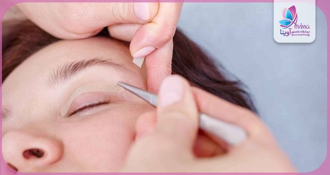 جدیدترین روشهای بلفاروپلاستی توسط بهترین جراح