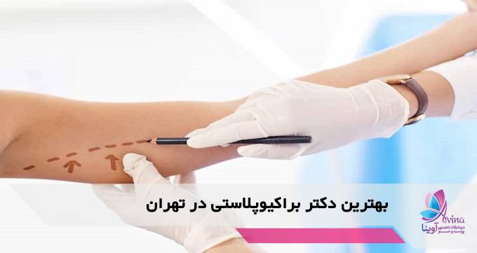 بهترین دکتر براکیوپلاستی در تهران