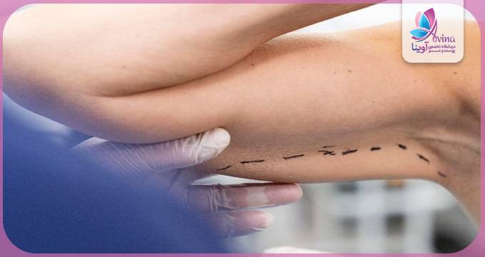 مزایای انتخاب دکتر متخصص براکیوپلاستی در تهران