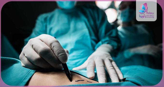 ویژگیهای بهترین دکتر لیپوساکشن در تهران