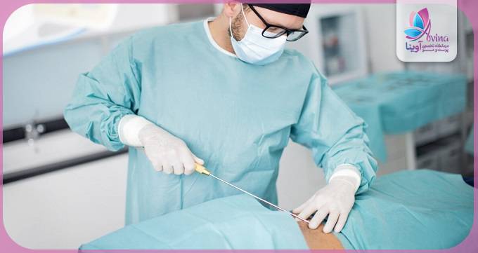 اقدامات مراقبتی پس از عمل لیپوساکشن در تهران