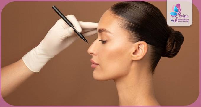 دوران نقاهت پس از عمل رینوپلاستی توسط بهترین جراح