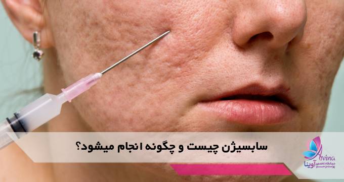 سابسیژن چیست و چگونه انجام میشود؟